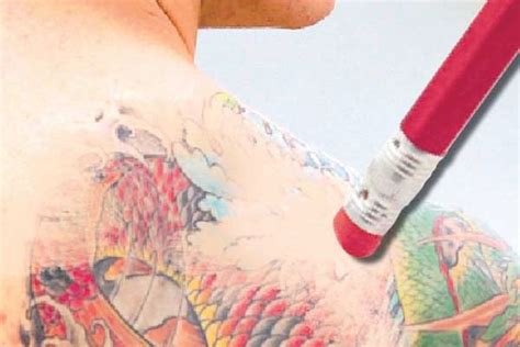 Tattoo removal as a businessthis is and introduction to how to do tattoo removal as a service in your community. Erase Your Past With Tattoo Removal Cream | Gephardt Daily