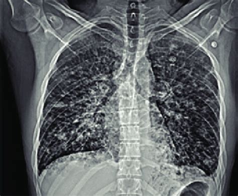 Chest Radiograph Showing Bilateral Nodular Opacities With A Lower Zone