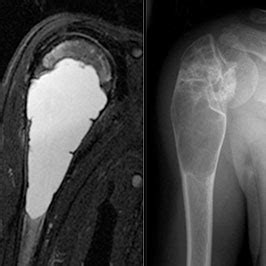 Unicameral Bone Cysts Treatment Rationale And Approach Current Concept Review Journal Of The