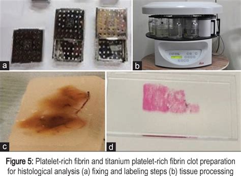 Figure 4 From Comparative Histologic Evaluation Of Titanium Platelet