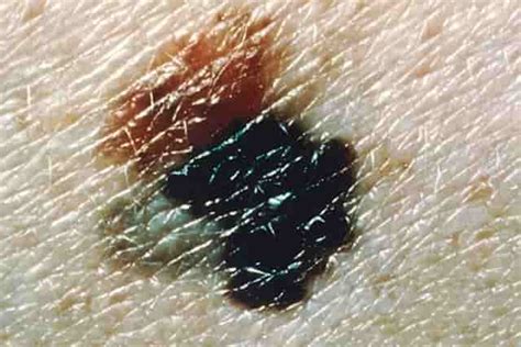 Black Dots On Skin Black Spots On Skin Causes Treatments Pictures