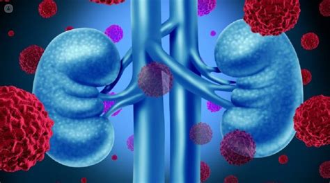 What Is Acute Renal Failure Top Doctors