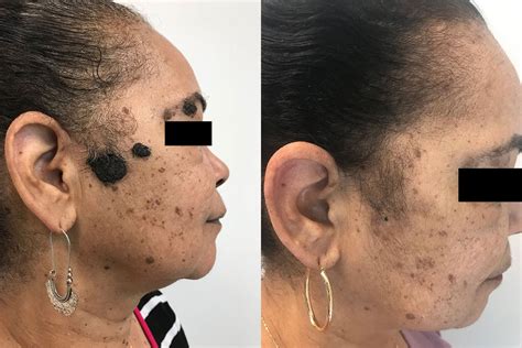 Mole Removal Eternal Dermatology Dermatologist