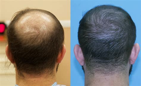 Fast Results After Fue Grafts Transplanted Carolina Hair Surgery