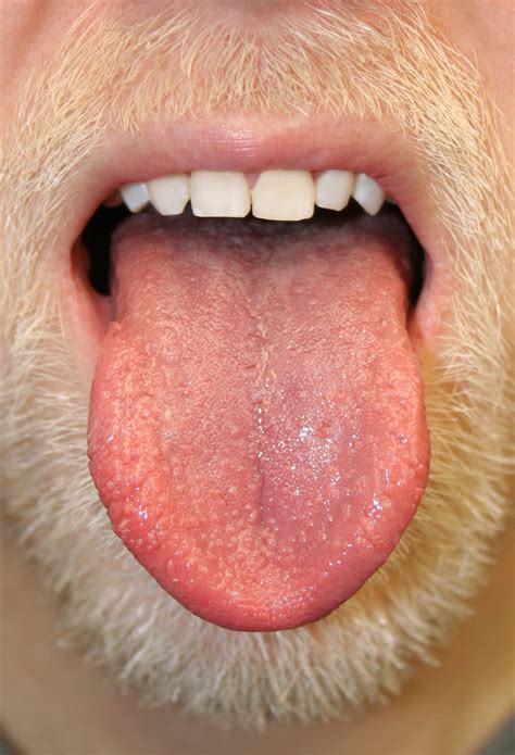 Bumps On The Tongue What It Could Mean Reader S Digest