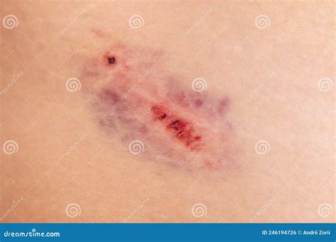 Closeup Bruise On Wounded Woman Leg Skin Domestic Violence Large