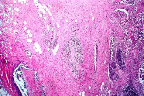 Breast Fibroadenosis Light Micrograph Photo Microscope Common Benign