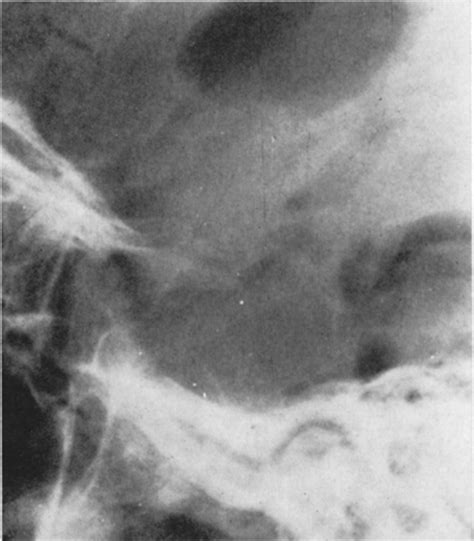 Galactorrhea In Males With Tumors In The Region Of The Pituitary Gland