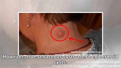 How is an epidermoid cyst diagnosed? How to Get Rid of a Sebaceous Cyst Naturally - YouTube