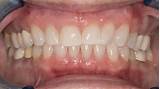 Pictures of Insurance Cover Teeth Whitening