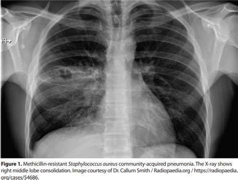 Community Acquired Pneumonia New Antibiotic Guidelines Essential