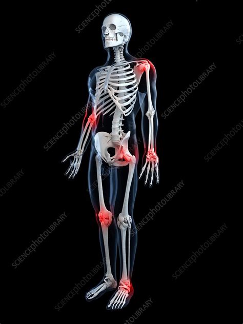 Joint Pain Conceptual Artwork Stock Image F0048018 Science