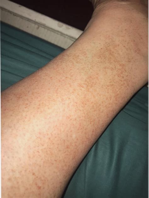 Pin By Karen Henry On Leg Freckles Skin Concern Freckles Beauty Hacks