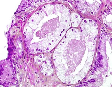 Foamy Gland Prostatic Adenocarcinoma Tumor Cells With Abundant Foamy