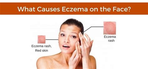 How To Treat Bad Eczema On Face