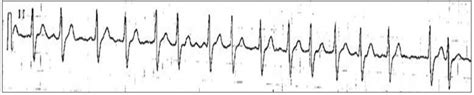 The Wandering Atrial Pacemaker Resources