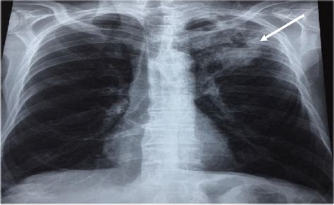 Chest X Ray Film Left Apical Excavated Opacity Arrows Show The