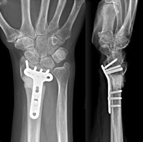 Pa And Lateral Of A Distal Radius Malunion Corrected With A Volar