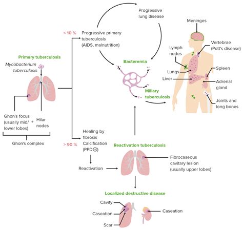 Tuberculosis Lungs Diagram