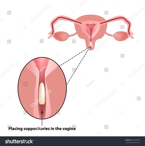 Treatment Vaginitis Suppositories Inflammation Vagina Infographics 스톡