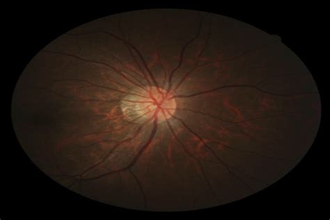 Optic Disc Features In Highly Myopic Eyes The Zoc Bhvi High