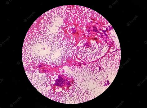 Premium Photo Photomicrograph Of Mucoepidermoid Carcinoma Of Parotid