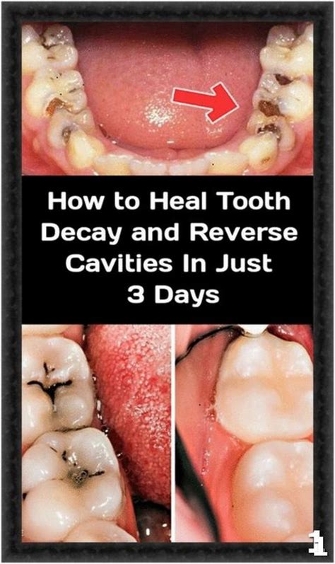 There is also a great book called cure tooth decay: Idea by Tilly Gamito on face mask in 2020 | Reverse ...