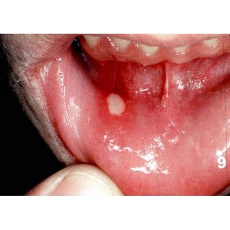 Mouth Ulcer Remedy Healthfully
