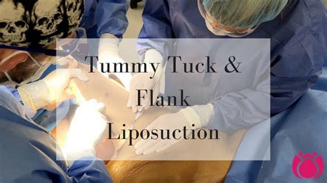 Tummy Tuck And Flank Liposuction Cosmetic Surgery Affiliates Youtube