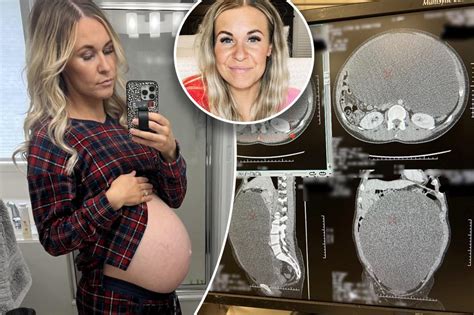 A Mother Reveals She Had A Giant 20lb Ovarian Cyst Removed