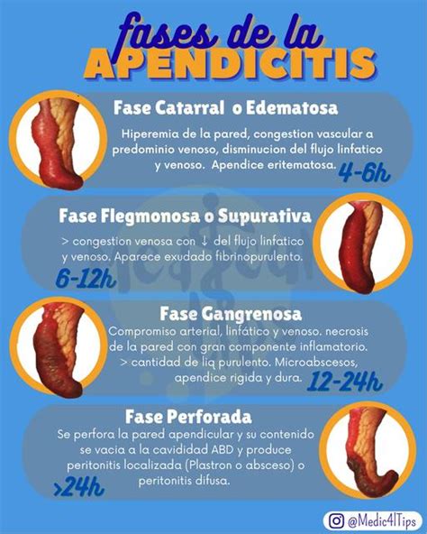 Fases De La Apendicitis Medical Tips Udocz
