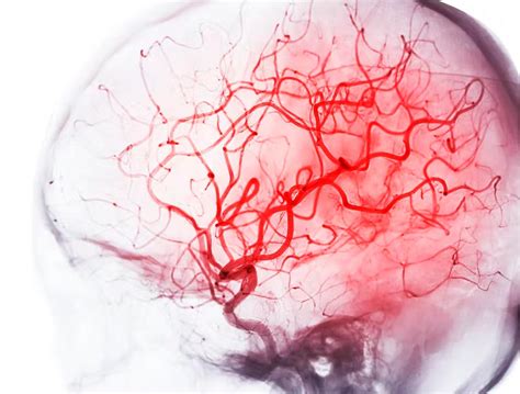 Explorando el sistema vascular cerebral con angiografía