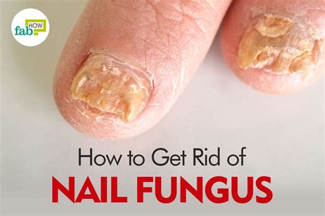 How To Get Rid Of Toenail Fungus Fab How