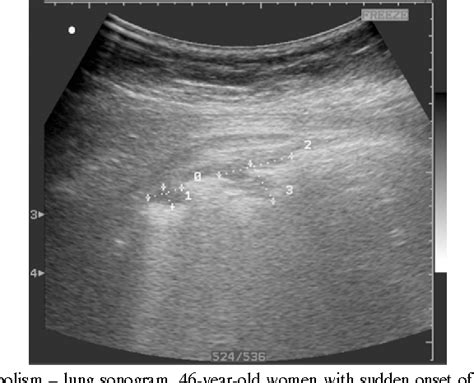 Figure 1 From Lung Ultrasound For Diagnosing Pulmonary Embolism Semantic Scholar