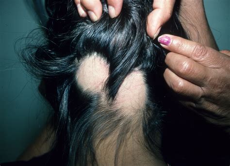 Top 124 Bald Spots In Women S Hair Polarrunningexpeditions