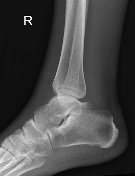 Soft Tissue Signs The Ankle Wikiradiography