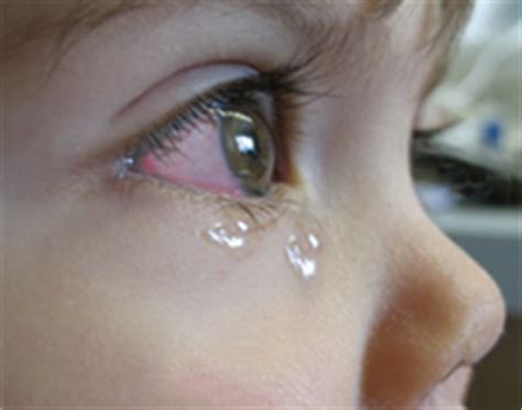 In those serious cases, treatment is needed to help clear up the infection. What is pink eye? An Explanation and what to do about it