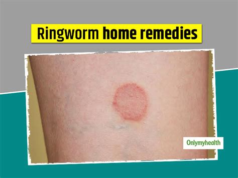 Ringworm Home Treatment Discover The Secret To Remove Ringworm