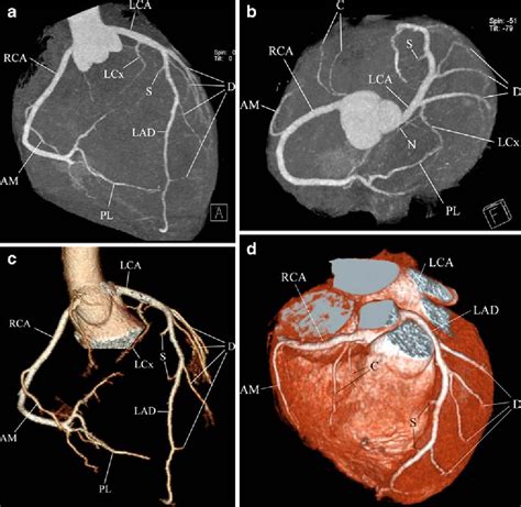 Coronary Artery Anomalies And Clinically Important Anatomy In Patients