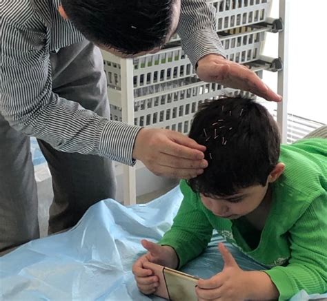 Acupuncture For Cerebral Palsy