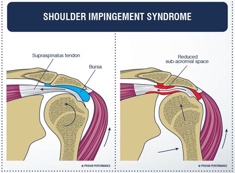 Shoulder Impingement Syndrome Manor Chiropractic