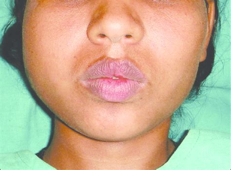Clinical Photograph Showing Diffuse Swelling Of The Right Side Of The