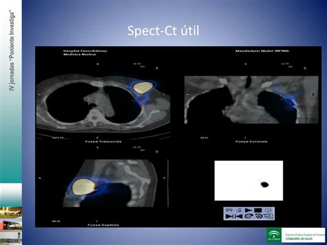 Ppt Spect Ct En Cirugía De Cáncer De Mama Nuestra Experiencia