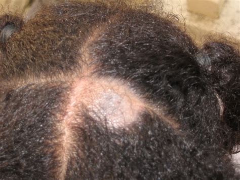 Know The Signs 6 Scalp Problems We May Have To Deal With At Some