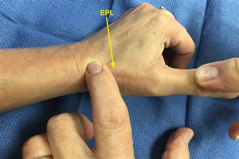 Extensor Tendon Exam Hand Surgery Source