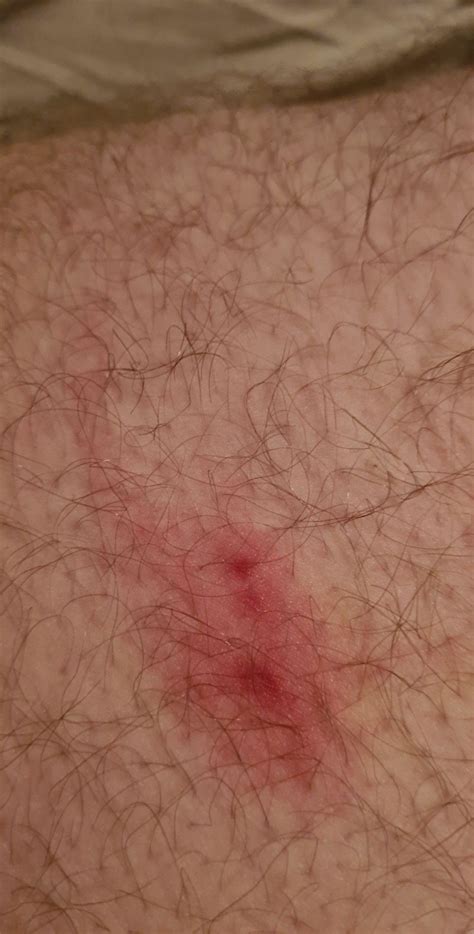 Rote flecken, die an den unteren extremitäten auftauchen, können unterschiedliche ursachen haben. Rote Flecken am Oberschenkel was ist das? (Gesundheit ...