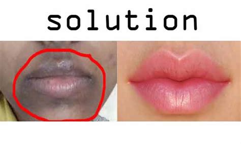 Why My Lips Get Black Spots
