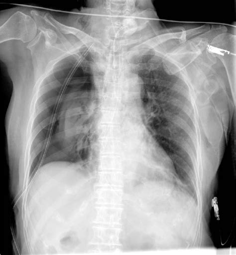 Figure 2 From Tension Pneumothorax After Percutaneous Tracheostomy