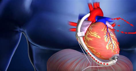 Reliantheart Announces European Clearance For New Lvad Medical Design