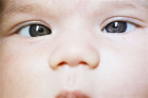 Crossed Eyes In Newborn Baby Eyes Cross